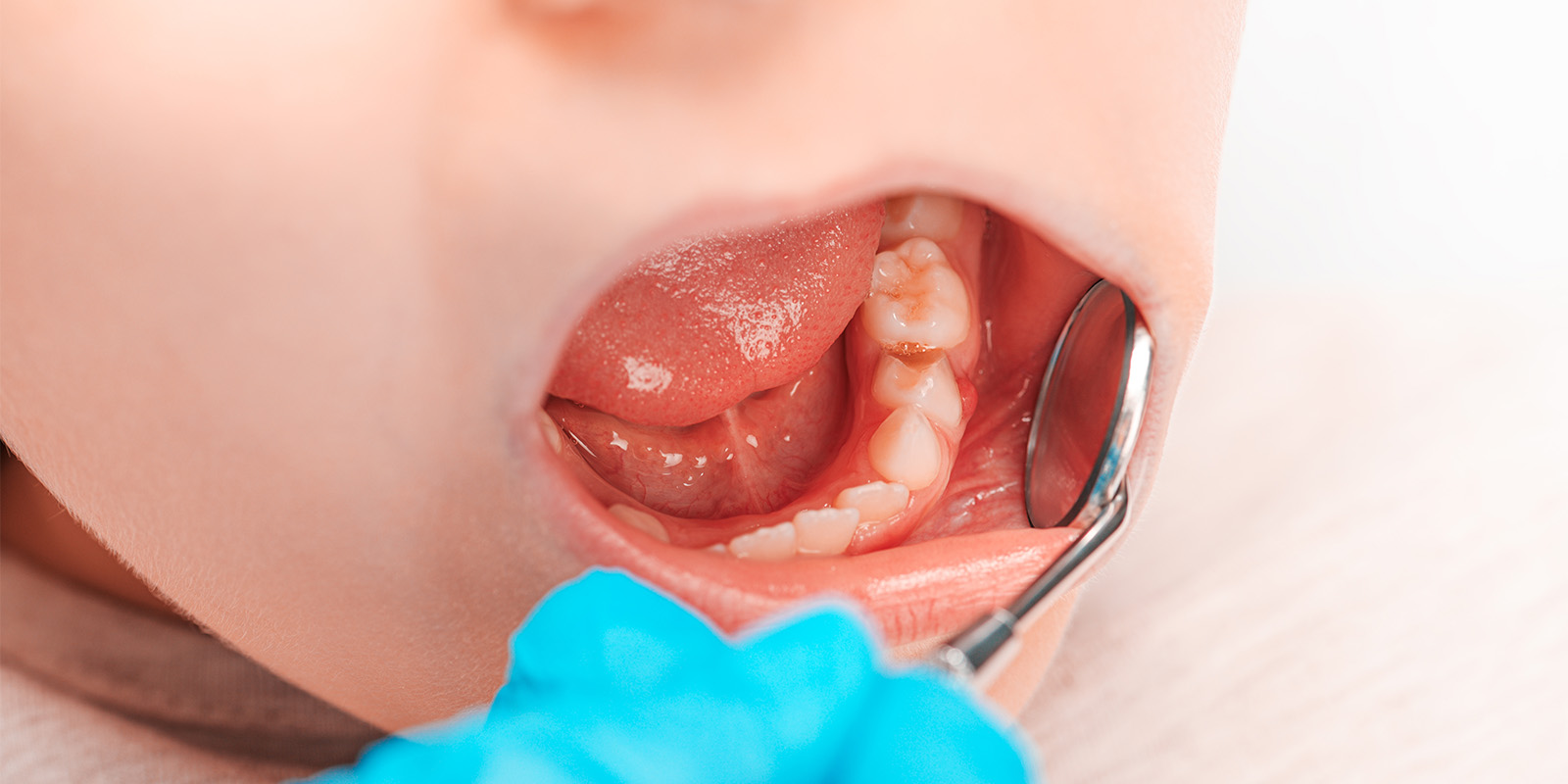 乳歯の虫歯について