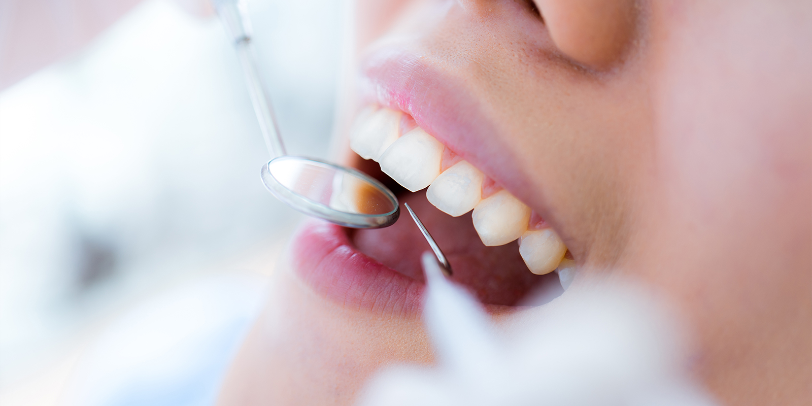 虫歯の予防方法